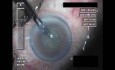 Cataract Surgery XII - Part 2