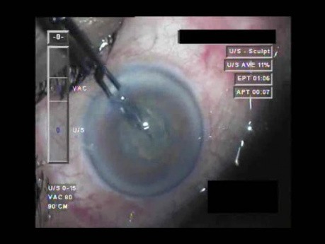 Cataract Surgery XII - Part 2