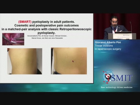 Trocar Incisions in Laparoscopic Surgery