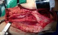 Ilio-Inguinal Lymphadenectomy, for Malignant melanoma