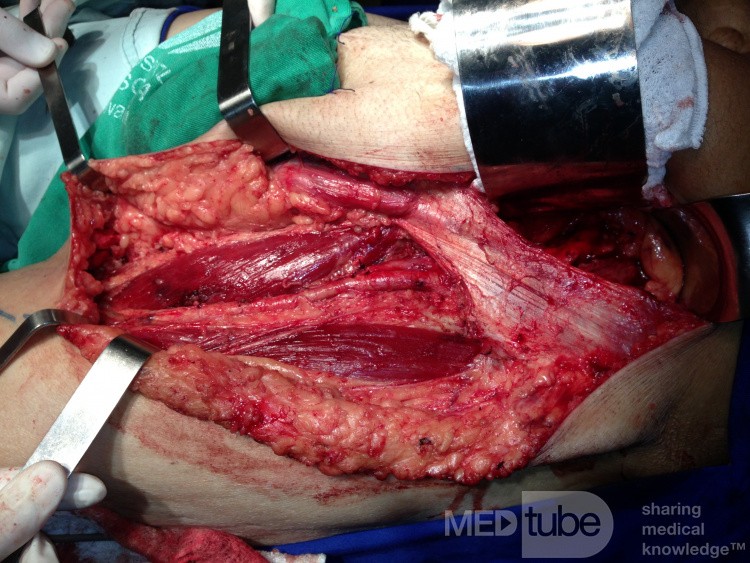 Ilio-Inguinal Lymphadenectomy, for Malignant melanoma