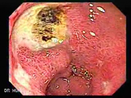Multiple Gastric Ulcers - Endoscopy (2 of 10)