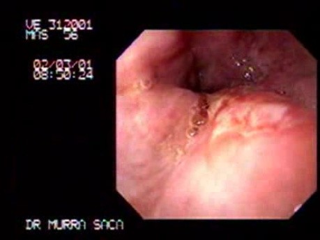 Ulcerative Adenocarcinoma of the Gasrtic Fudnus And Cardias