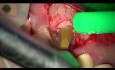 Esthetic Implant Therapy Using YSGG Laser