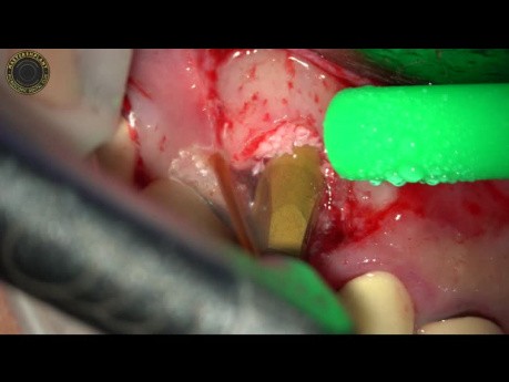 Esthetic Implant Therapy Using YSGG Laser
