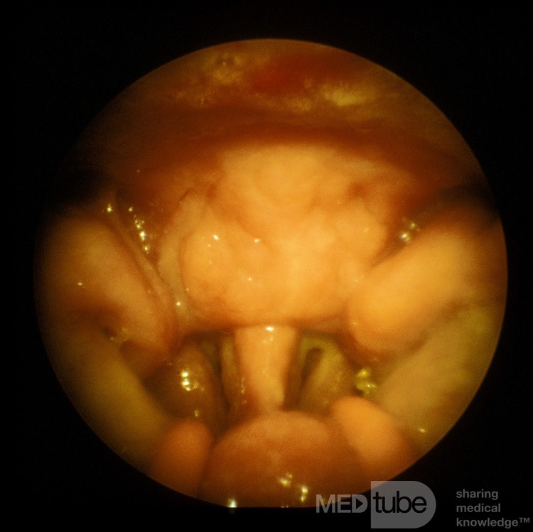 Sarcoidosis of the Roof of the Nasopharynx