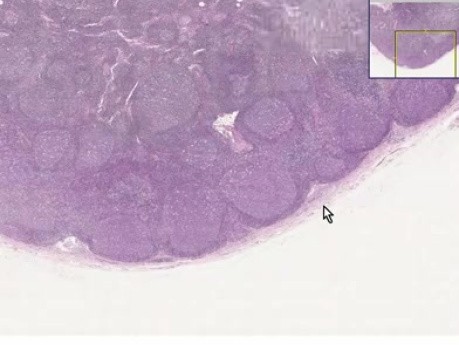 Follicular hyperplasia