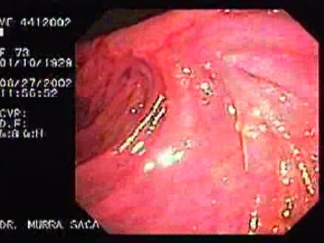 Gastric Adenocarcinoma With Signet Ring Cells - Endoscopy (4 of 4)