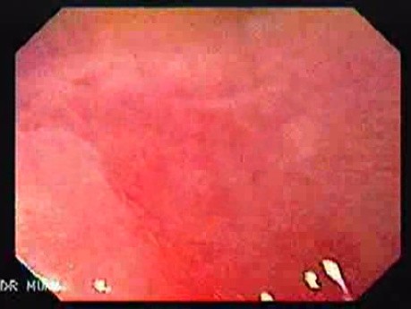 Barrett Esophagus -retroflexed view (3 of 6)