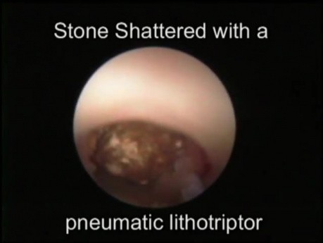 Endoscopic Lithotripsy Procedure