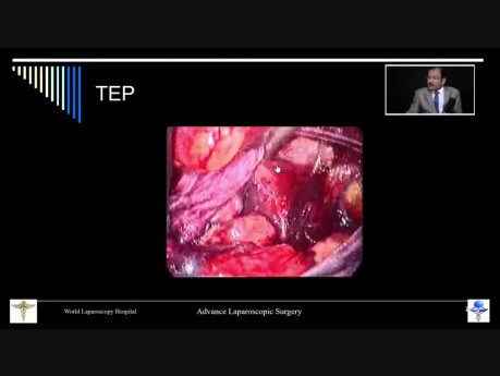 Extra-Peritoneal Hernia Surgery