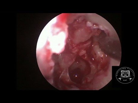Endoscopic Tympanoplasty for Cholesteatoma 