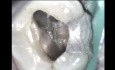 Endodontic Bone Regeneration 