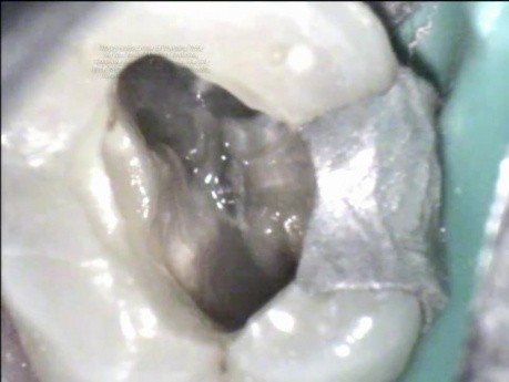 Endodontic Bone Regeneration 