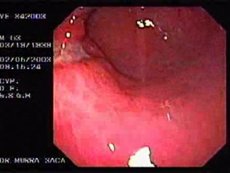 Gastric Ulcer with Irregular Borders - 63 Years-Old Male
