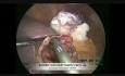 Laparoscopic Cystogastrostomy For Pancreatic Pseudocyst