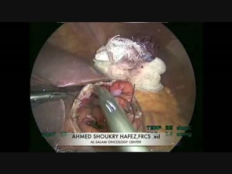 Laparoscopic Cystogastrostomy For Pancreatic Pseudocyst