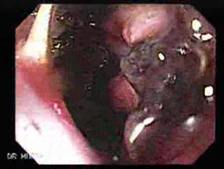 Adenocarcinoma of the Cardia and Carcinoma Epidermoid of the Larynx (17 of 26)