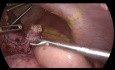 Laparoscopic Conversion Sleeve Gastrectomy to Roux en Y Bypass with Hiatal Hernia Repair
