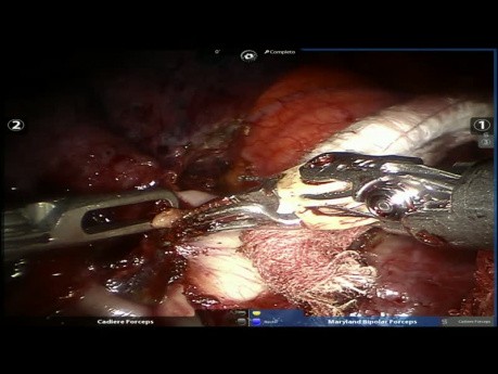 Left Upper Robotic Lobectomy