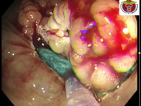 Laterally Spreading Tumor EMR in the Right Colon