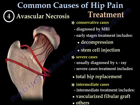 Common causes of Hip Pain - Video Lecture