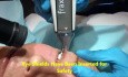 Fraxel Repair Laser Resurfacing for Wrinkles & Skin Tightening & Acne Scars