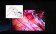 Uniportal Thoracoscopic Stapler Insertion During Lobectomy. 
