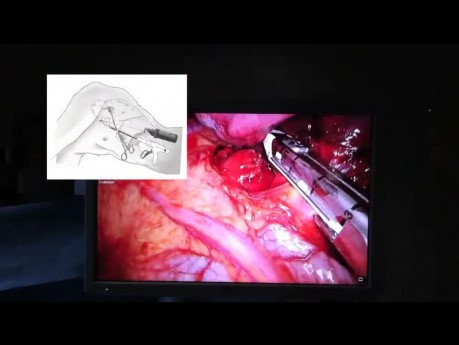 Uniportal Thoracoscopic Stapler Insertion During Lobectomy. 