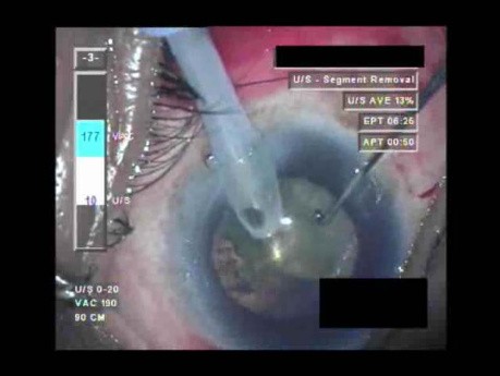 Cataract Surgery X - Part 3