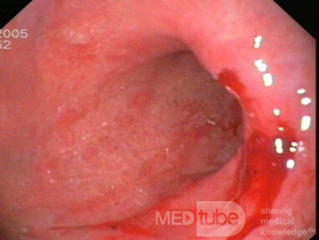 Endoscopy - Active Chronic Gastropathy