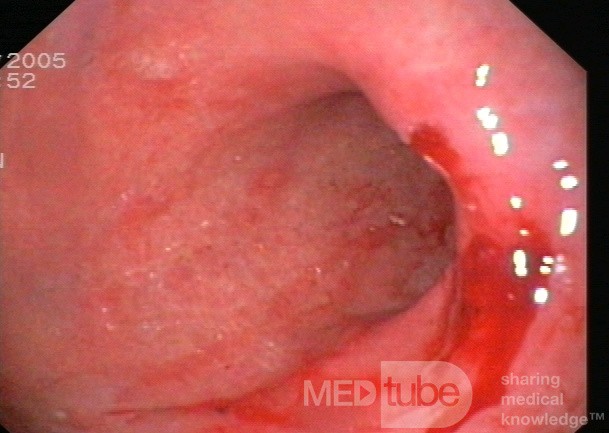 Endoscopy - Active Chronic Gastropathy