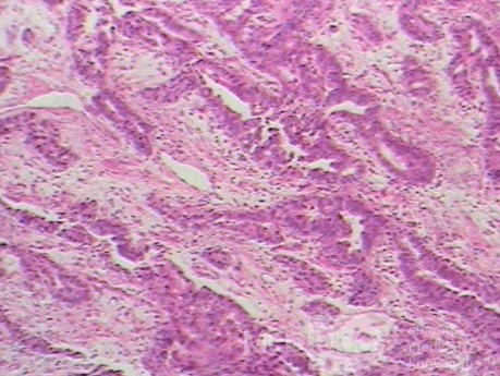 Barrett Adenocarcinoma - Endoscopic Image  (5 of 20)