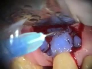 Root Resorption Repair
