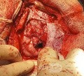Surgical Planning with Neuronavigator in Patient with Intracranial Mass Lesion. High Grade Glioma.