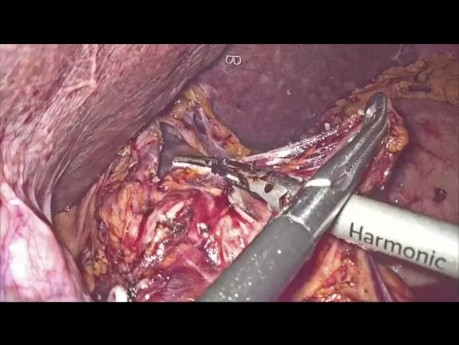 Laparoscopic Gastrectomy for Distal Gastric Cancer