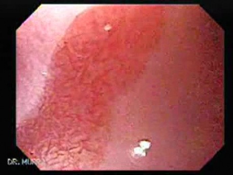 Duodenal Ulcer (3 of 4)