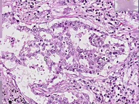 Lung Adenocarcinoma