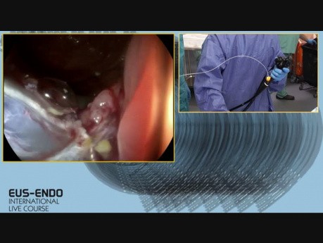 Endoscopic Resection of the Caecal Polyp
