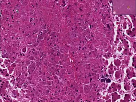 Histoplasmosis