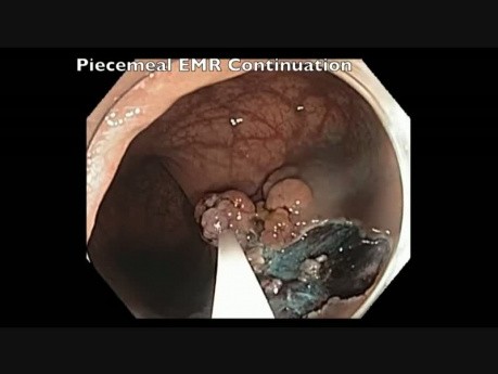 Colonoscopy - Rectal Tumor - Laterally Spreading Granular Tumor - Piecemeal EMR