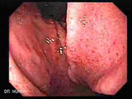 Acute Gastritis (1 of 62