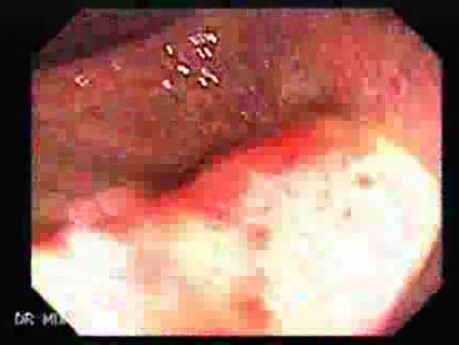 Colitis Ulcerosa - Pancolitis (5 of 7)