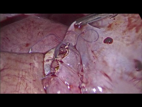 Recurrent Contralateral Consecutive Ectopic Pregnancy