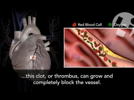 Atherosclerosis