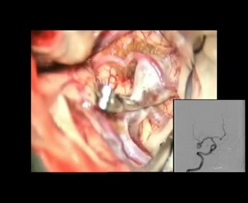 Middle Cerebral Artery (MCA) Aneurysm