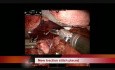 Robot Assisted Transabdominal Distal Esophageal Leiomyoma Enucleation
