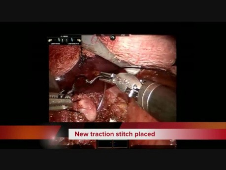 Robot Assisted Transabdominal Distal Esophageal Leiomyoma Enucleation