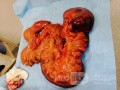 Constipation as a Cause of Megacolon and Multiorgan Failure