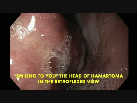 Giant Pedunculated Mixed Mesenchymal Tumor - Hamartoma of the Oesophagus